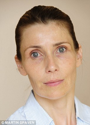 acupunctura faciala dupa