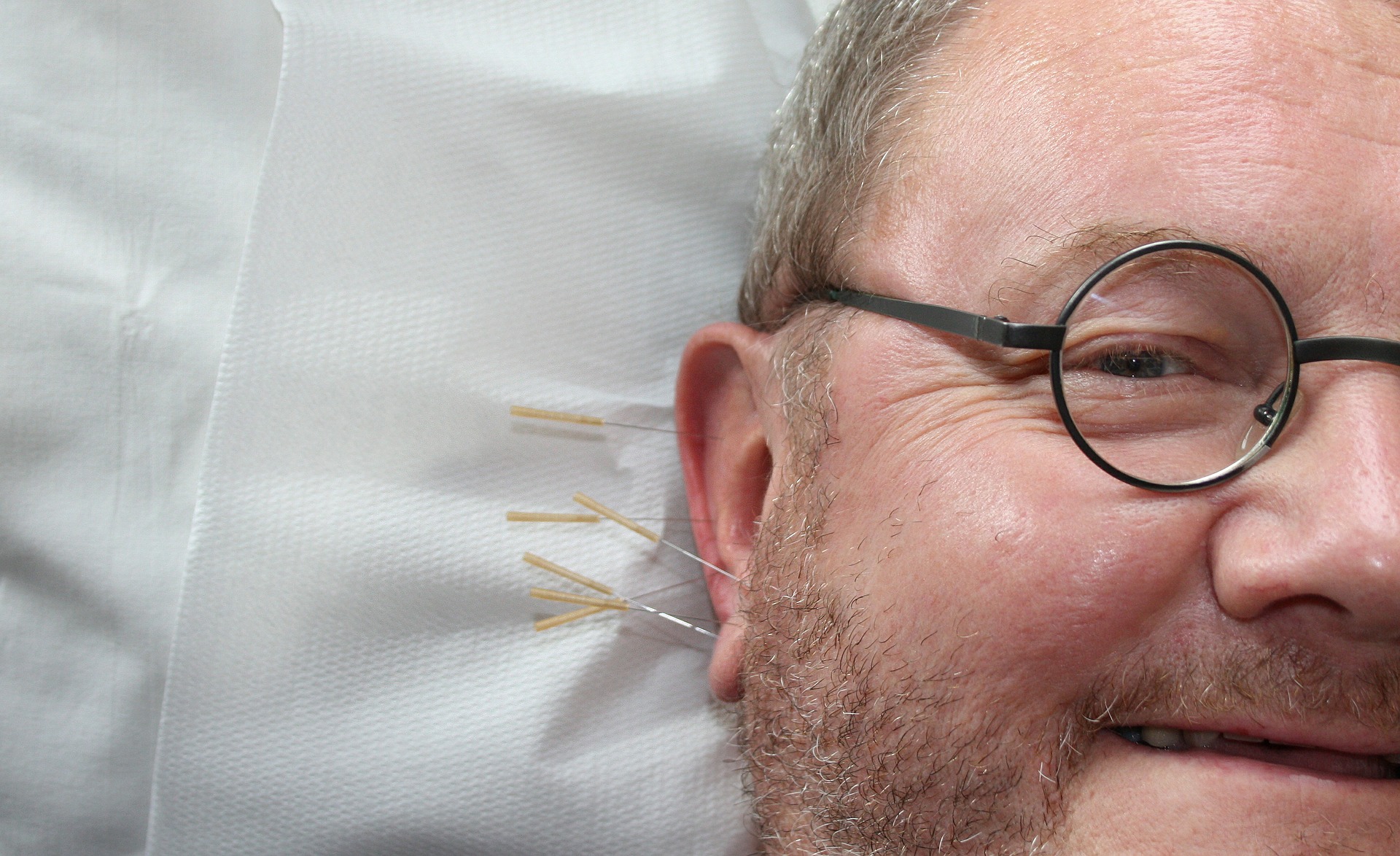 acupunctura vindecare tratare