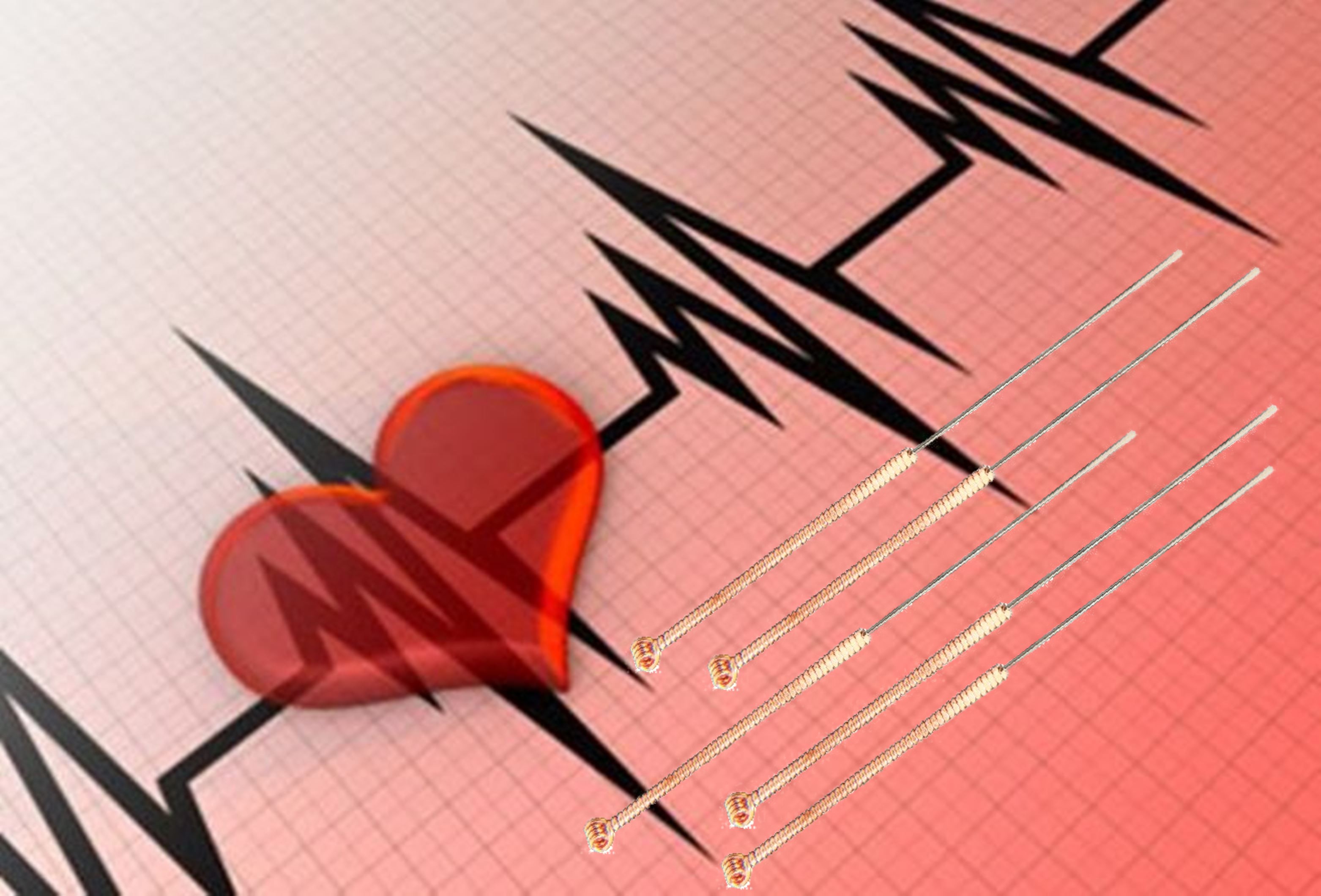aritmie cardiaca acupunctura